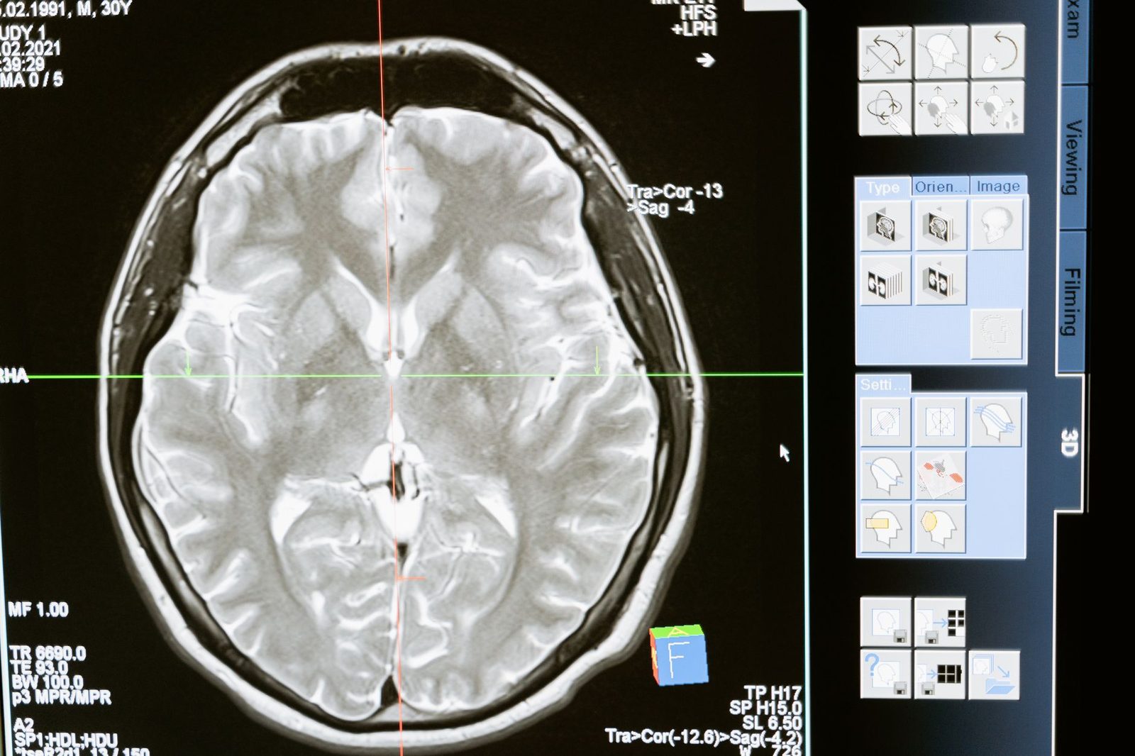 MRI scan of a human brain shown on a computer screen for medical review.