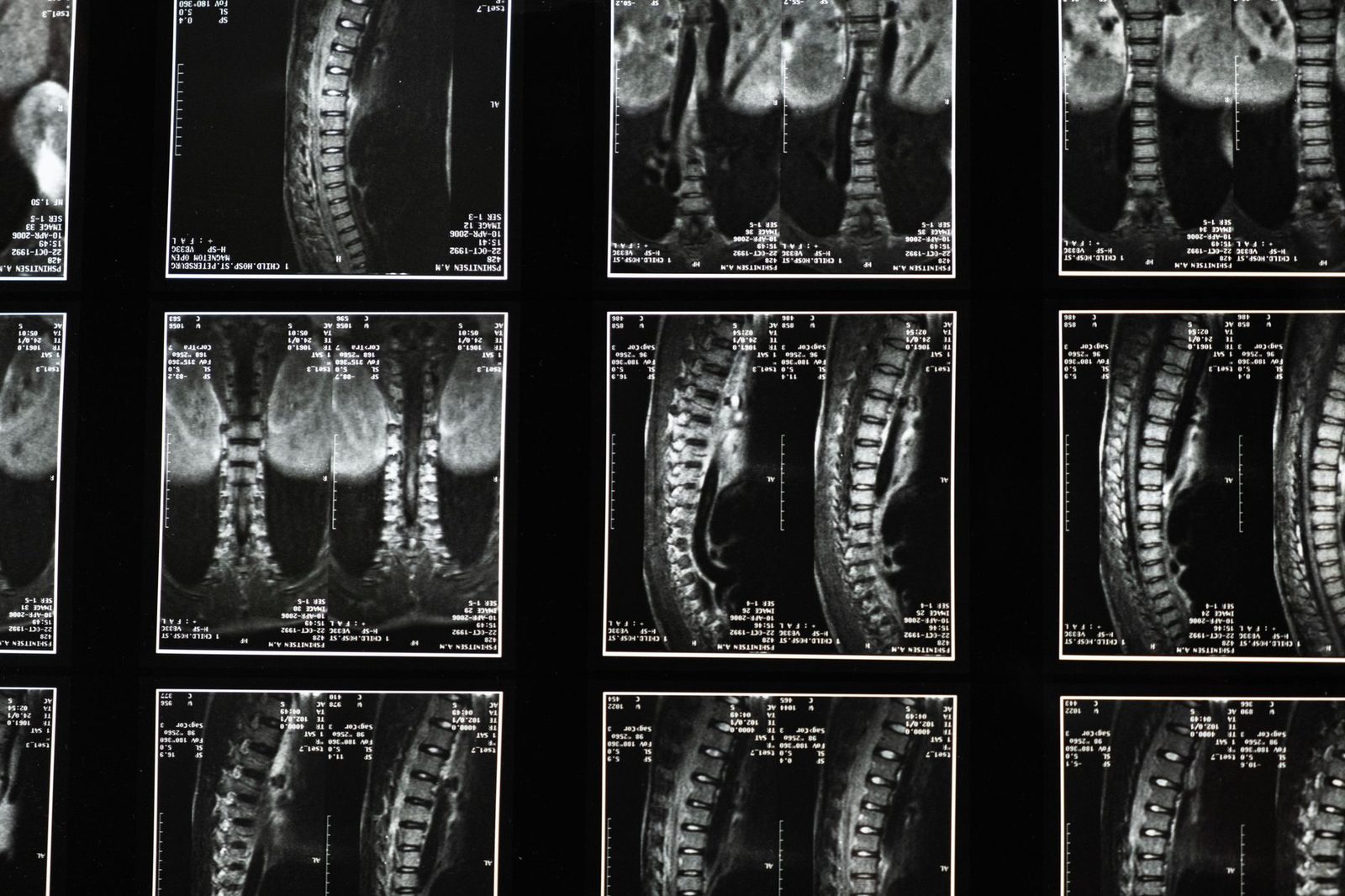 X-ray of the cervical spine showing the neck vertebrae in lateral view.